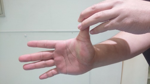 痛い 腱鞘炎 の 付け根 が 親指